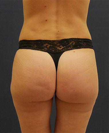 Vaser Liposuction Before & After Patient #225